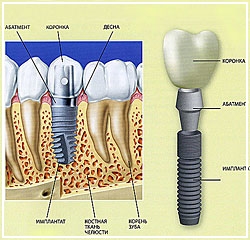 Имплантация зубов